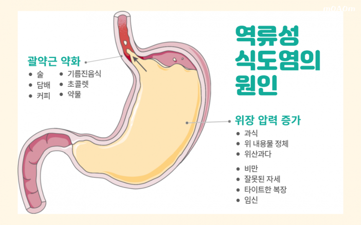 역류성-식도염-원인.png